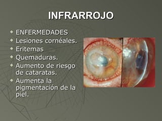 INFRARROJO
   ENFERMEDADES
   Lesiones cornéales.
   Eritemas
   Quemaduras.
   Aumento de riesgo
    de cataratas.
   Aumenta la
    pigmentación de la
    piel.
 