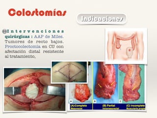 Colostomías Indicaciones
I n t e r v e n c i o n e s
quirúrgicas : AAP de Miles.
Tumores de recto bajos.
Proctocolectomía en CU con
afectación distal resistente
al tratamiento,
 