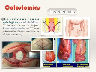 Colostomías Indicaciones
I n t e r v e n c i o n e s
quirúrgicas : AAP de Miles.
Tumores de recto bajos.
Proctocolectomía en CU con
afectación distal resistente
al tratamiento,
 