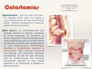 Colostomías Tipos
Terminales: Son las más comunes .
Se realizan sobre todo con sigma y
colon descendente. No hay continuidad
distal . Pueden realizarse en cualquier
segmento si se precisara
En Asa:Es un procedimiento que
permite desviar el tránsito intestinal
en forma temporal, sin desviarlo en
forma completa. Tiene la ventaja sobre
otras colostomías que es de fácil cierre
ya que solo requiere una cirugía local y
no una laparotomía. Desventaja,
decúbito y hundimiento asociado a
peritonitis. Hay nuevas técnicas
quirúrgicas que permiten efectuar
colostomías en asa de tipo terminal,
que se confeccionan con suturas
mecánicas dejando el cabo distal
adherido a la colostomía a manera de
fístula mucosa.
 