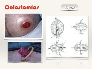Colostomías Tipos
 