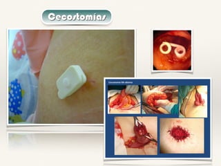 Cecostomías
 