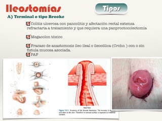 Ileostomías Tipos
A) Terminal o tipo Brooke
Colitis ulcerosa con pancolitis y afectación rectal extensa
refractaria a tratamiento y que requiera una panproctocolectomía
Megacolon tóxico
Fracaso de anastomosis ileo ileal o ileocólica (Crohn ) con o sin
fístula mucosa asociada.
PAF
 