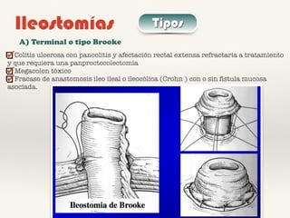 Ileostomías Tipos
A) Terminal o tipo Brooke
Colitis ulcerosa con pancolitis y afectación rectal extensa refractaria a tratamiento
y que requiera una panproctocolectomía
Megacolon tóxico
Fracaso de anastomosis ileo ileal o ileocólica (Crohn ) con o sin fístula mucosa
asociada.
 