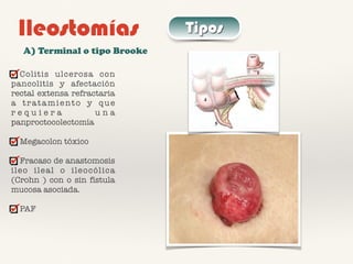 Ileostomías Tipos
A) Terminal o tipo Brooke
Colitis ulcerosa con
pancolitis y afectación
rectal extensa refractaria
a tratamiento y que
r e q u i e r a u n a
panproctocolectomía
Megacolon tóxico
Fracaso de anastomosis
ileo ileal o ileocólica
(Crohn ) con o sin fístula
mucosa asociada.
PAF
 