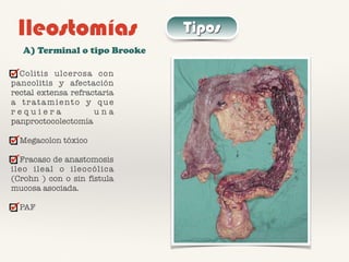 Ileostomías Tipos
A) Terminal o tipo Brooke
Colitis ulcerosa con
pancolitis y afectación
rectal extensa refractaria
a tratamiento y que
r e q u i e r a u n a
panproctocolectomía
Megacolon tóxico
Fracaso de anastomosis
ileo ileal o ileocólica
(Crohn ) con o sin fístula
mucosa asociada.
PAF
 
