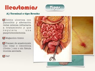 Ileostomías Tipos
A) Terminal o tipo Brooke
Colitis ulcerosa con
pancolitis y afectación
rectal extensa refractaria
a tratamiento y que
r e q u i e r a u n a
panproctocolectomía
Megacolon tóxico
Fracaso de anastomosis
ileo ileal o ileocólica
(Crohn ) con o sin fístula
mucosa asociada.
PAF
 