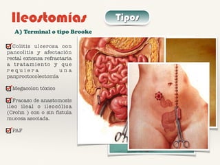 Ileostomías Tipos
A) Terminal o tipo Brooke
Colitis ulcerosa con
pancolitis y afectación
rectal extensa refractaria
a tratamiento y que
r e q u i e r a u n a
panproctocolectomía
Megacolon tóxico
Fracaso de anastomosis
ileo ileal o ileocólica
(Crohn ) con o sin fístula
mucosa asociada.
PAF
 