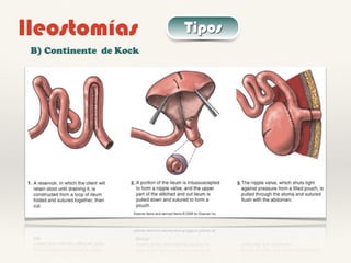 Ileostomías Tipos
B) Continente de Kock
 