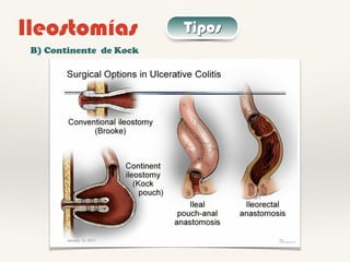Ileostomías Tipos
B) Continente de Kock
 