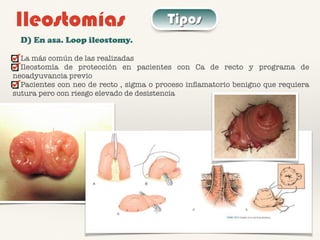 Ileostomías Tipos
D) En asa. Loop ileostomy.
La más común de las realizadas
Ileostomía de protección en pacientes con Ca de recto y programa de
neoadyuvancia previo
Pacientes con neo de recto , sigma o proceso inﬂamatorio benigno que requiera
sutura pero con riesgo elevado de desistencia
 