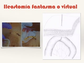 Ileostomía fantasma o virtual
 