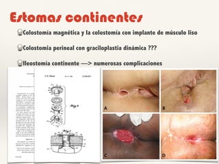 Estomas continentes
Colostomía magnética y la colostomía con implante de músculo liso
Colostomia perineal con graciloplastia dinámica ???
Ileostomía continente —> numerosas complicaciones
 