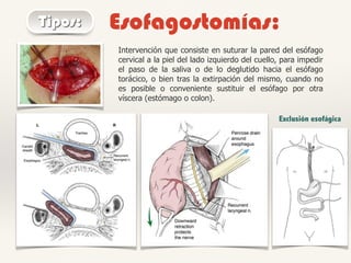 Tipos: Esofagostomías:
Intervención que consiste en suturar la pared del esófago
cervical a la piel del lado izquierdo del cuello, para impedir
el paso de la saliva o de lo deglutido hacia el esófago
torácico, o bien tras la extirpación del mismo, cuando no
es posible o conveniente sustituir el esófago por otra
víscera (estómago o colon).
Exclusión esofágica
 