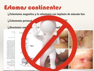 Estomas continentes
Colostomía magnética y la colostomía con implante de músculo liso
Colostomia perineal con graciloplastia dinámica ???
Ileostomía continente —> numerosas complicaciones
 