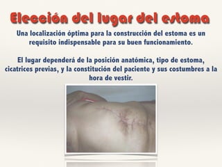 Elección del lugar del estoma
Una localización óptima para la construcción del estoma es un
requisito indispensable para su buen funcionamiento.
El lugar dependerá de la posición anatómica, tipo de estoma,
cicatrices previas, y la constitución del paciente y sus costumbres a la
hora de vestir.
 