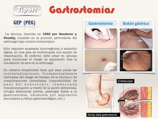 GastrostomíasTipos:
La técnica, descrita en 1980 por Gauderer y
Ponsky, consiste en la punción percutánea del
estómago bajo control endoscópico
Sólo requiere anestesia locorregional y sedación
ligera, en una sala de endoscopias con equipo de
reanimación. El enfermo debe estar en ayunas
para minimizar el riesgo de aspiración tras la
insuﬂación de aire en el estómago.
Su relativa simplicidad hace que sean pocas las
contraindicaciones, fundamentalmente
derivadas del riesgo de fracaso de la técnica o de
complicaciones inmediatas (imposibilidad de
p a s o d e l e n d o s c o p i o , i n a d e c u a d a
transiluminación a través de la pared abdominal,
cirugía abdominal previa, patología distal a la
gastrostomía, neumonía por aspiración
secundaria a reﬂujo gastroesofágico, etc.)
GEP (PEG)
 