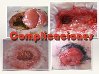 Complicaciones
 