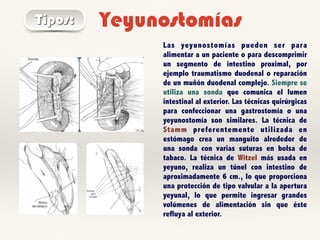 YeyunostomíasTipos:
Las yeyunostomías pueden ser para
alimentar a un paciente o para descomprimir
un segmento de intestino proximal, por
ejemplo traumatismo duodenal o reparación
de un muñón duodenal complejo. Siempre se
utiliza una sonda que comunica el lumen
intestinal al exterior. Las técnicas quirúrgicas
para confeccionar una gastrostomía o una
yeyunostomía son similares. La técnica de
Stamm preferentemente utilizada en
estómago crea un manguito alrededor de
una sonda con varias suturas en bolsa de
tabaco. La técnica de Witzel más usada en
yeyuno, realiza un túnel con intestino de
aproximadamente 6 cm., lo que proporciona
una protección de tipo valvular a la apertura
yeyunal, lo que permite ingresar grandes
volúmenes de alimentación sin que éste
refluya al exterior.
 
