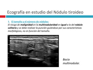 Ecografía en estudio del Nódulo tiroideo 
1. El tamaño y el número de nódulos: 
El riesgo de malignidad en la multinodularidad en igual a la del nódulo 
solitario y se debe realizar la punción guiándose por sus características 
morfológicas, no en función del tamaño. 
Bocio 
multinodular. 
 