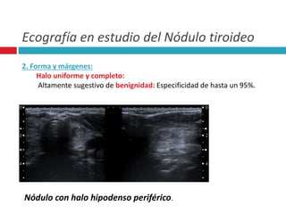 Ecografía en estudio del Nódulo tiroideo 
2. Forma y márgenes: 
Halo uniforme y completo: 
Altamente sugestivo de benignidad: Especificidad de hasta un 95%. 
Nódulo con halo hipodenso periférico. 
 