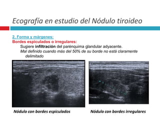 Ecografía en estudio del Nódulo tiroideo 
2. Forma y márgenes: 
Bordes espiculados o irregulares: 
Sugiere infiltración del parénquima glandular adyacente. 
Mal definido cuando más del 50% de su borde no está claramente 
delimitado 
Nódulo con bordes espiculados Nódulo con bordes irregulares 
 
