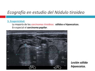 Ecografía en estudio del Nódulo tiroideo 
3. Ecogenicidad: 
La mayoría de los carcinomas tiroideos: sólidos e hipoecoicos. 
En especial el carcinoma papilar. 
Lesión sólida 
hipoecoica. 
 