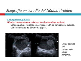 Ecografía en estudio del Nódulo tiroideo 
4. Componente quístico: 
Nódulos completamente quísticos son de naturaleza benigna. 
Solo un 2.5% de los carcinomas mas del 50% de componente quístico. 
Variante quística del carcinoma papilar. 
Lesión quística 
con 
componente 
sólido 
periférico. 
 