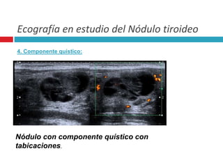 Ecografía en estudio del Nódulo tiroideo 
4. Componente quístico: 
Nódulo con componente quístico con 
tabicaciones. 
 