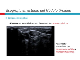 Ecografía en estudio del Nódulo tiroideo 
4. Componente quístico: 
Adenopatías metastásicas: más frecuentes los cambios quísticos. 
Adenopatía 
sospechosa con 
componente quístico y 
microcalcificaciones. 
 
