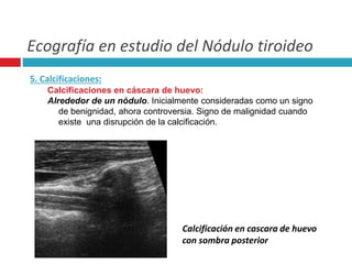 Ecografía en estudio del Nódulo tiroideo 
5. Calcificaciones: 
Calcificaciones en cáscara de huevo: 
Alrededor de un nódulo. Inicialmente consideradas como un signo 
de benignidad, ahora controversia. Signo de malignidad cuando 
existe una disrupción de la calcificación. 
Calcificación en cascara de huevo 
con sombra posterior 
 