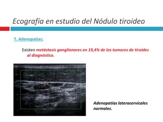 Ecografía en estudio del Nódulo tiroideo 
7. Adenopatías: 
Existen metástasis ganglionares en 19,4% de los tumores de tiroides 
al diagnóstico. 
Adenopatías laterocervicales 
normales. 
 