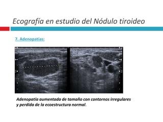 Ecografía en estudio del Nódulo tiroideo 
7. Adenopatías: 
Adenopatía aumentada de tamaño con contornos irregulares 
y perdida de la ecoestructura normal. 
 