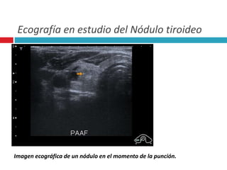 Ecografía en estudio del Nódulo tiroideo 
Imagen ecográfica de un nódulo en el momento de la punción. 
 