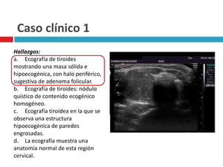 Caso clínico 1 
Hallazgos: 
a. Ecografía de tiroides 
mostrando una masa sólida e 
hipoecogénica, con halo periférico, 
sugestiva de adenoma folicular. 
b. Ecografía de tiroides: nódulo 
quístico de contenido ecogénico 
homogéneo. 
c. Ecografía tiroidea en la que se 
observa una estructura 
hipoecogénica de paredes 
engrosadas. 
d. La ecografía muestra una 
anatomía normal de esta región 
cervical. 
 