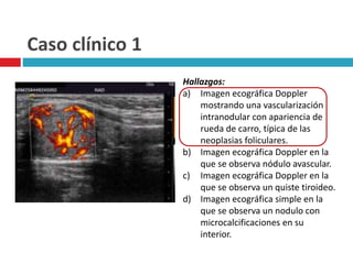 Caso clínico 1 
Hallazgos: 
a) Imagen ecográfica Doppler 
mostrando una vascularización 
intranodular con apariencia de 
rueda de carro, típica de las 
neoplasias foliculares. 
b) Imagen ecográfica Doppler en la 
que se observa nódulo avascular. 
c) Imagen ecográfica Doppler en la 
que se observa un quiste tiroideo. 
d) Imagen ecográfica simple en la 
que se observa un nodulo con 
microcalcificaciones en su 
interior. 
 