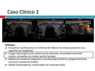 Caso Clínico 2 
Hallazgos: 
a) Se aprecian calcificaciones en el interior del nódulo con refuerzo posterior, muy 
sugestivas de malignidad. 
b) Imagen hipoecogénica con contornos bien definidos, de probable contenido 
coloide, compatible con nódulo quístico benigno. 
c) Nódulo con contornos irregulares y vascularización periférica, patognomónico de 
carcinoma medular de tiroides. 
d) Nódulo hiperecogénico, encapsulado con contenido sólido. 
 