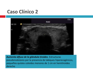 Caso Clínico 2 
Aumento difuso de la glándula tiroides. Estructuras 
pseudonodulares por la presencia de tabiques hiperecogénicos, 
pequeños quistes coloides menores de 1 cm en hemitiroides 
derecho 
 