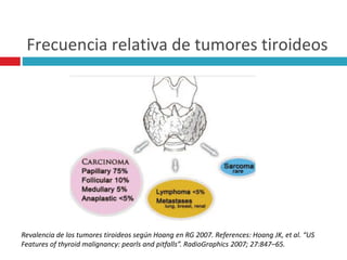 Frecuencia relativa de tumores tiroideos 
Revalencia de los tumores tiroideos según Hoang en RG 2007. References: Hoang JK, et al. “US 
Features of thyroid malignancy: pearls and pitfalls”. RadioGraphics 2007; 27:847–65. 
 