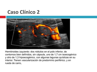 Caso Clínico 2 
Hemitiroides izquierdo: dos nódulos en el polo inferior, de 
contornos bien definidos, sin cápsula, uno de 1,7 cm isoecogénico 
y otro de 1,3 hipoecogénico, con algunas lagunas quísticas en su 
interior. Tienen vascularización de predominio periférico, y en 
rueda de carro, 
 