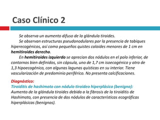 Caso Clínico 2 
Se observa un aumento difuso de la glándula tiroides. 
Se observan estructuras pseudonodulares por la presencia de tabiques 
hiperecogénicos, así como pequeños quistes coloides menores de 1 cm en 
hemitiroides derecho. 
En hemitiroides izquierdo se aprecian dos nódulos en el polo inferior, de 
contornos bien definidos, sin cápsula, uno de 1,7 cm isoecogénico y otro de 
1,3 hipoecogénico, con algunas lagunas quísticas en su interior. Tiene 
vascularización de predominio periférico. No presenta calcificaciones. 
Diagnóstico: 
Tiroiditis de hashimoto con nódulo tiroideo hiperplásico (benigno): 
Aumento de la glándula tiroides debida a la fibrosis de la tiroiditis de 
Hashimoto, con presencia de dos nódulos de características ecográficas 
hiperplásicas (benignos). 
 
