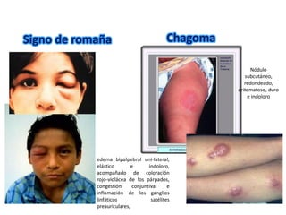 Nódulo
subcutáneo,
redondeado,
eritematoso, duro
e indoloro
Signo de romaña Chagoma
edema bipalpebral uni-lateral,
elástico e indoloro,
acompañado de coloración
rojo-violácea de los párpados,
congestión conjuntival e
inflamación de los ganglios
linfáticos satélites
preauriculares,
 