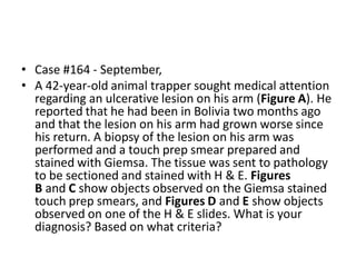 • Case #164 - September,
• A 42-year-old animal trapper sought medical attention
regarding an ulcerative lesion on his arm (Figure A). He
reported that he had been in Bolivia two months ago
and that the lesion on his arm had grown worse since
his return. A biopsy of the lesion on his arm was
performed and a touch prep smear prepared and
stained with Giemsa. The tissue was sent to pathology
to be sectioned and stained with H & E. Figures
B and C show objects observed on the Giemsa stained
touch prep smears, and Figures D and E show objects
observed on one of the H & E slides. What is your
diagnosis? Based on what criteria?
 