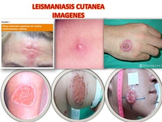 LEISMANIASIS CUTANEA
IMAGENES
 