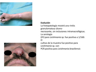 Evolución
La histopatología mostró una rinitis
granulomatosa úlcero-
necrosante, sin inclusiones intramacrofágicas.
La serología
(IFI) para Leishmania sp. fue positiva a 1/160.
El
cultivo de la muestra fue positivo para
Leishmania sp. con
PCR positiva para Leishmania braziliensis
 