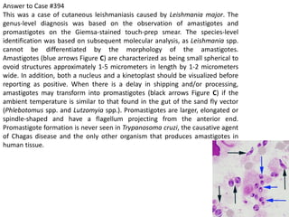 Answer to Case #394
This was a case of cutaneous leishmaniasis caused by Leishmania major. The
genus-level diagnosis was based on the observation of amastigotes and
promastigotes on the Giemsa-stained touch-prep smear. The species-level
identification was based on subsequent molecular analysis, as Leishmania spp.
cannot be differentiated by the morphology of the amastigotes.
Amastigotes (blue arrows Figure C) are characterized as being small spherical to
ovoid structures approximately 1-5 micrometers in length by 1-2 micrometers
wide. In addition, both a nucleus and a kinetoplast should be visualized before
reporting as positive. When there is a delay in shipping and/or processing,
amastigotes may transform into promastigotes (black arrows Figure C) if the
ambient temperature is similar to that found in the gut of the sand fly vector
(Phlebotomus spp. and Lutzomyia spp.). Promastigotes are larger, elongated or
spindle-shaped and have a flagellum projecting from the anterior end.
Promastigote formation is never seen in Trypanosoma cruzi, the causative agent
of Chagas disease and the only other organism that produces amastigotes in
human tissue.
 