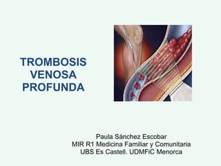 TROMBOSIS VENOSA PROFUNDA Paula Sánchez Escobar MIR R1 Medicina Familiar y Comunitaria UBS Es Castell. UDMFiC Menorca 