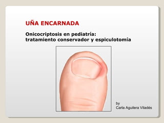 UÑA ENCARNADA Onicocriptosis en pediatría:  tratamiento conservador y espiculotomía by Carla Aguilera Viladés 