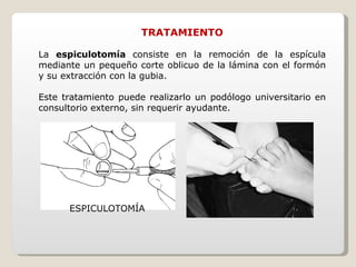 TRATAMIENTO La  espiculotomía  consiste en la remoción de la espícula mediante un pequeño corte oblicuo de la lámina con el formón y su extracción con la gubia. Este tratamiento puede realizarlo un podólogo universitario en consultorio externo, sin requerir ayudante. ESPICULOTOMÍA 