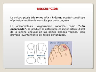 DESCRIPCIÓN La onicocriptosis (de  onyx,  uña y  kriptos , oculto) constituye el  principal motivo de consulta por dolor ungueal. La onicocriptosis, vulgarmente conocida como  “uña encarnada” , se produce al enterrarse el sector lateral distal de la lámina ungueal en las partes blandas vecinas. Esto provoca levantamiento del tejido periungueal. 